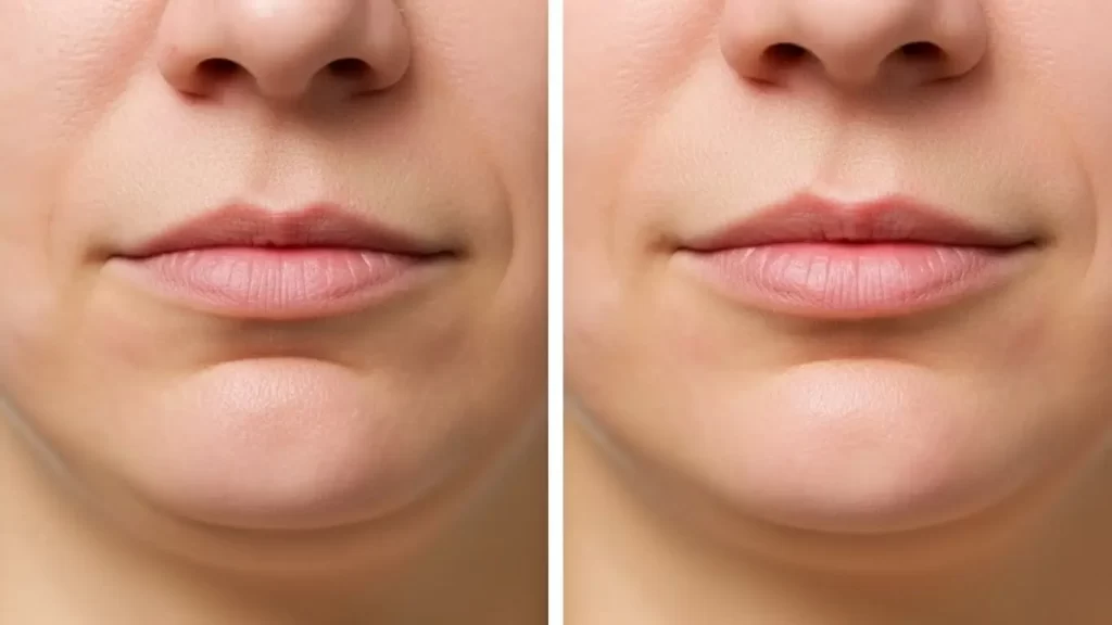 Rid of Chin Wrinkles